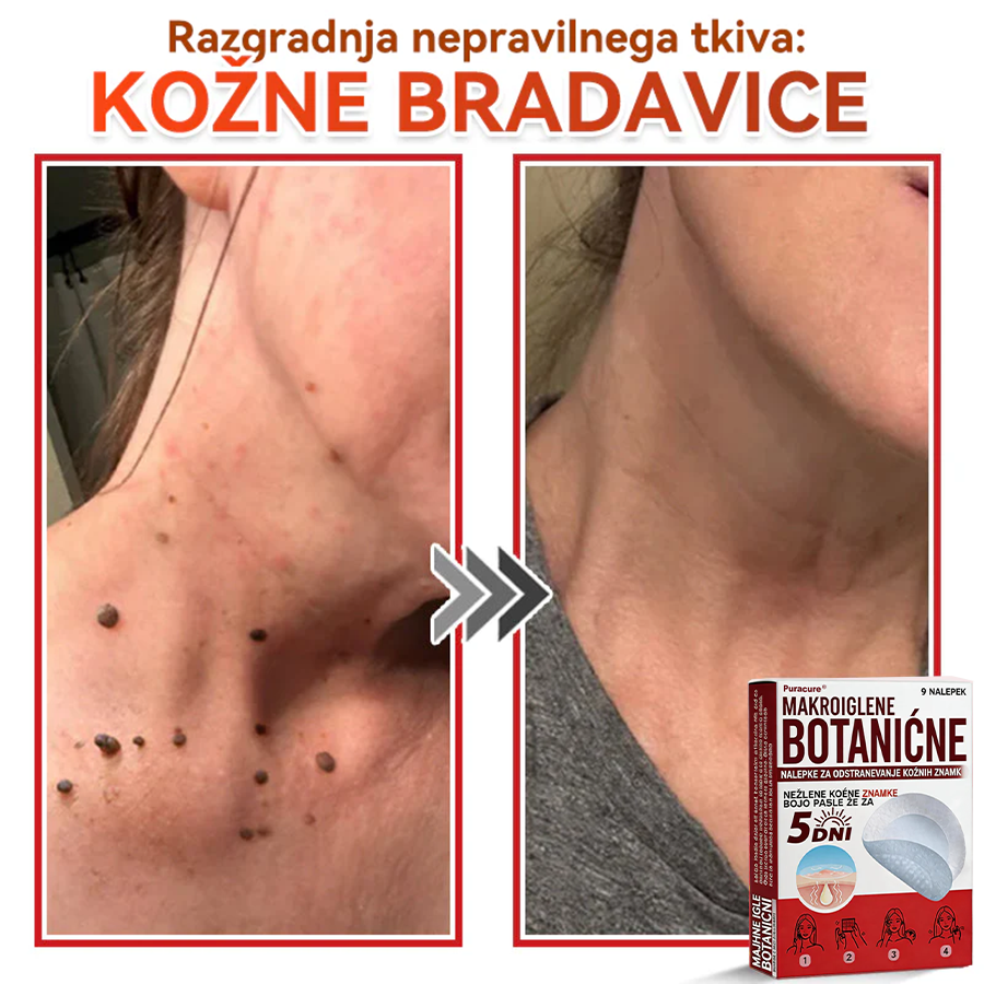 🗽✅PuraCure®Botanični obliž z mikroiglami za odstranjevanje kožnih izrastkov