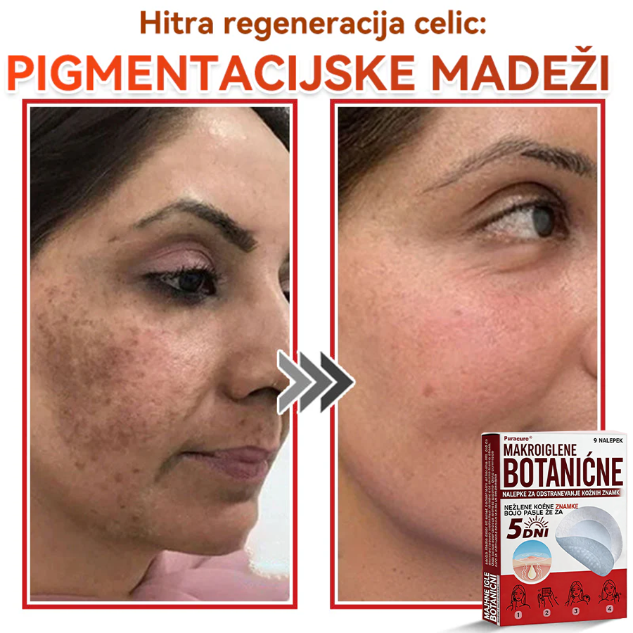 🗽✅PuraCure®Botanični obliž z mikroiglami za odstranjevanje kožnih izrastkov
