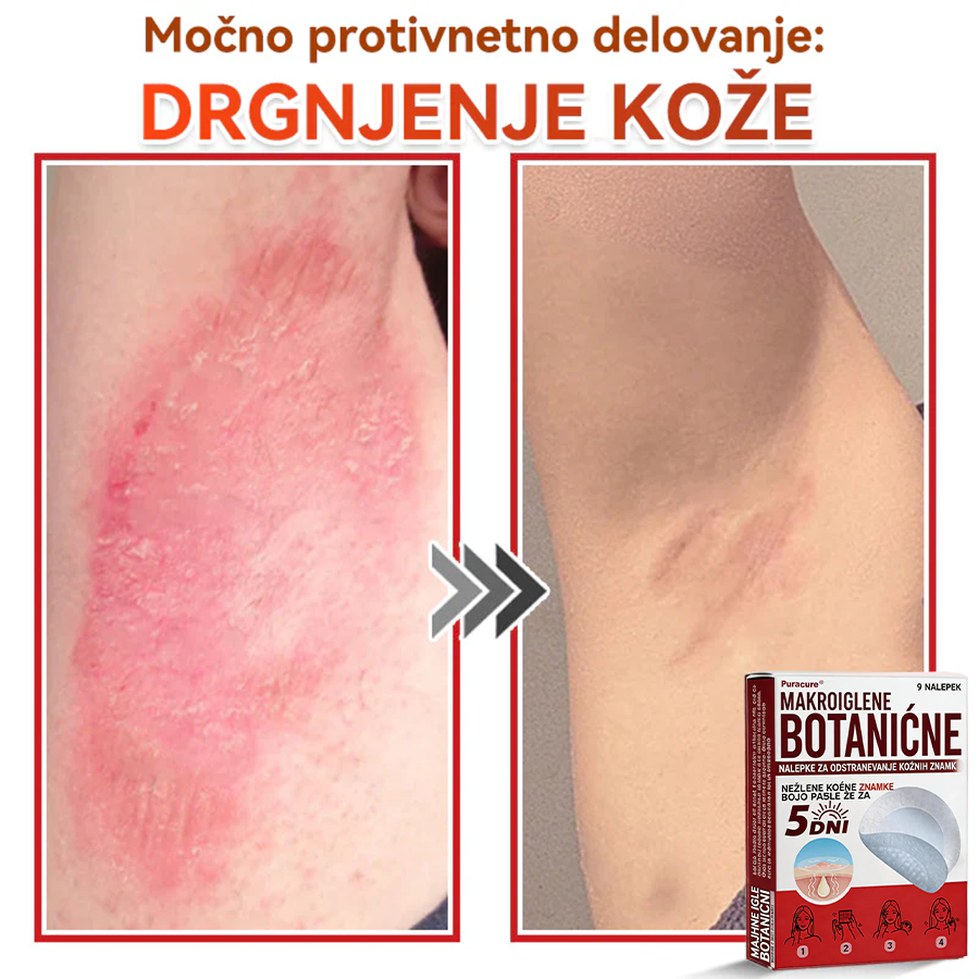 🗽✅PuraCure®Botanični obliž z mikroiglami za odstranjevanje kožnih izrastkov