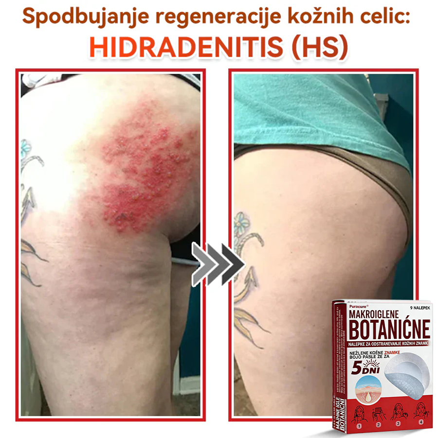 🗽✅PuraCure®Botanični obliž z mikroiglami za odstranjevanje kožnih izrastkov