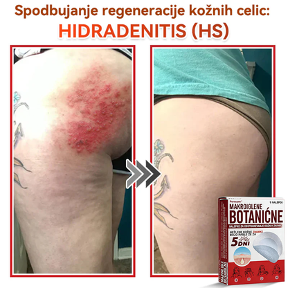 🗽✅PuraCure®Botanični obliž z mikroiglami za odstranjevanje kožnih izrastkov