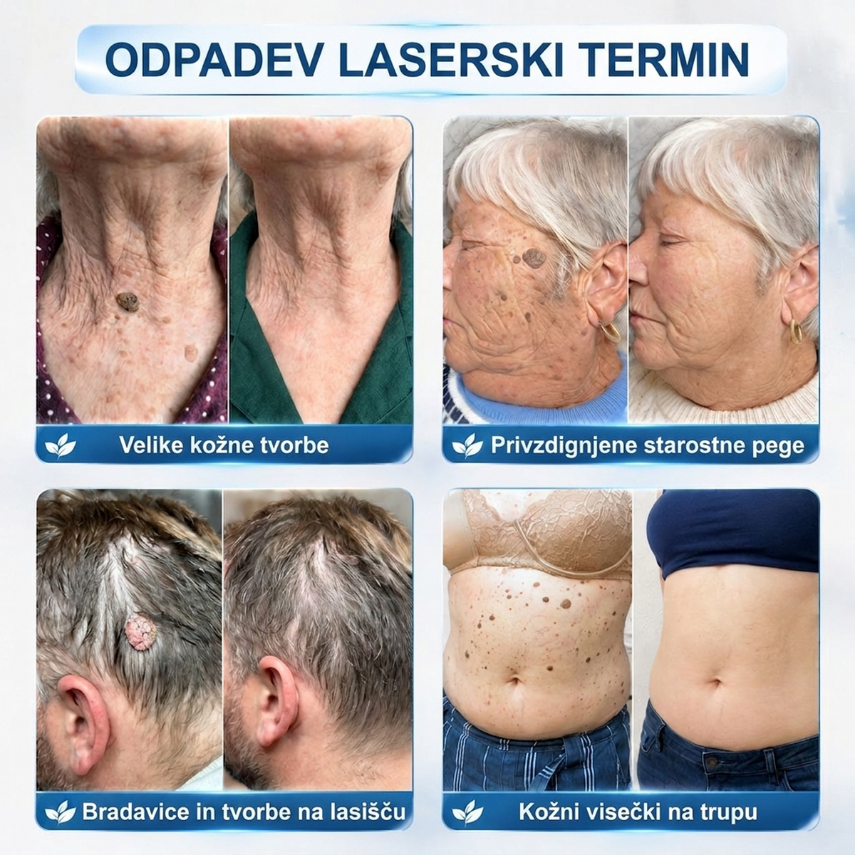 🥇🥇PuraCure®👩‍⚕️ Rezultati so vidni že v 7 dneh! Valjček za odstranjevanje bradavic in drugih kožnih težav | Neboleče in minimalno razmaže.