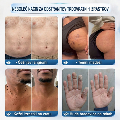 🥇🥇PuraCure®👩‍⚕️ Rezultati so vidni že v 7 dneh! Valjček za odstranjevanje bradavic in drugih kožnih težav | Neboleče in minimalno razmaže.