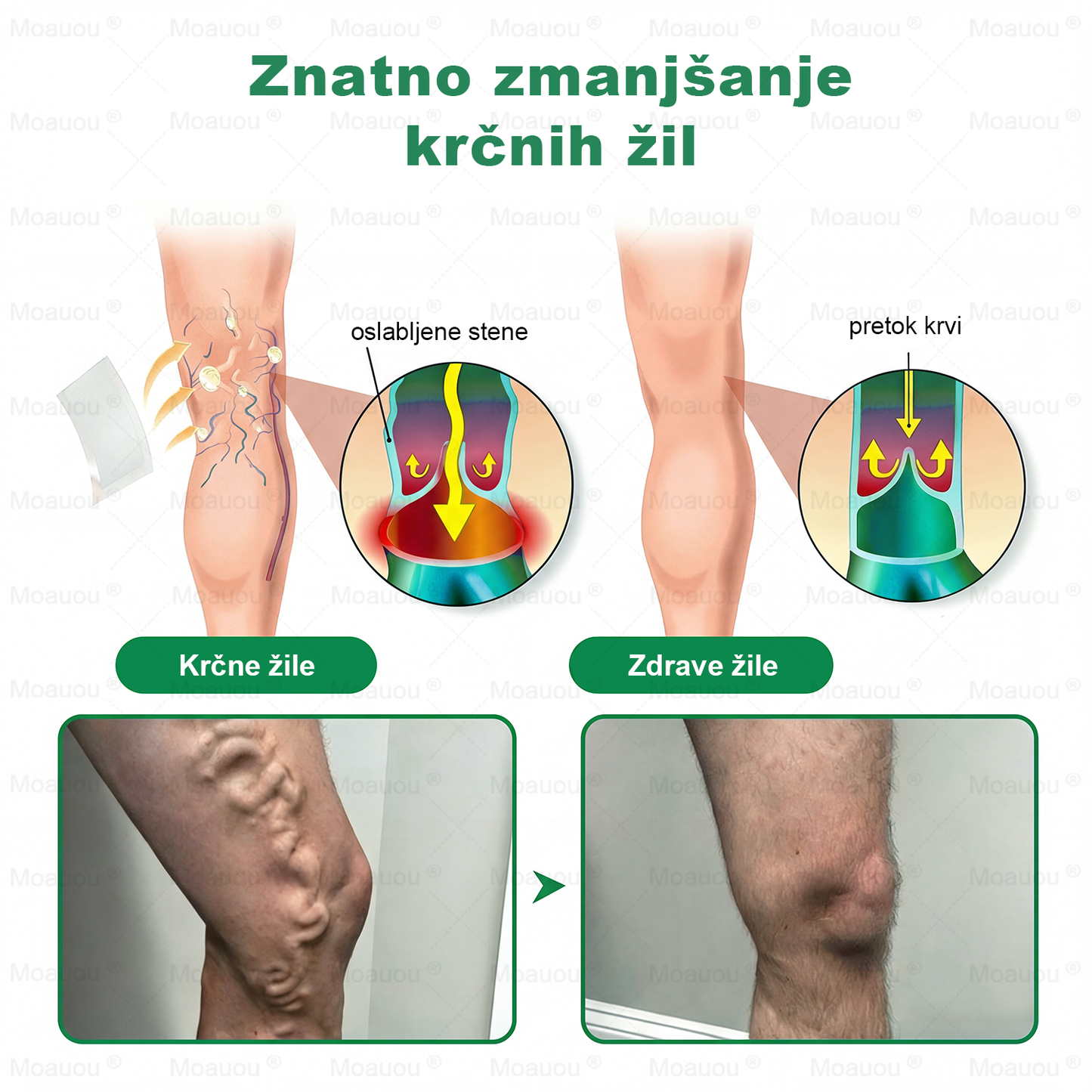 👨‍⚕️Moauou® VeinTarget Mikron Needl Patch⚡Takojšnja Olajšava, Dolgoročni Rezultati - Velika Razprodaja