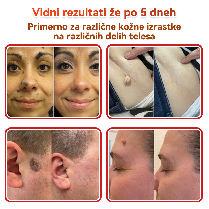 🗽✅PuraCure®Botanični obliž z mikroiglami za odstranjevanje kožnih izrastkov