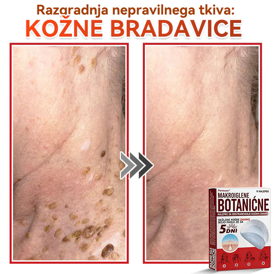 🗽✅PuraCure®Botanični obliž z mikroiglami za odstranjevanje kožnih izrastkov
