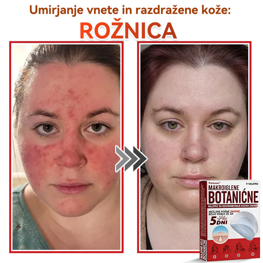 🗽✅PuraCure®Botanični obliž z mikroiglami za odstranjevanje kožnih izrastkov