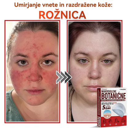🗽✅PuraCure®Botanični obliž z mikroiglami za odstranjevanje kožnih izrastkov